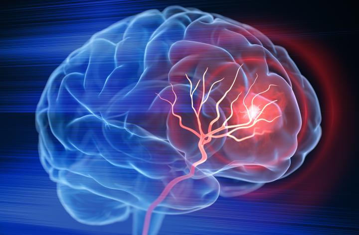 Dementia and strokes
