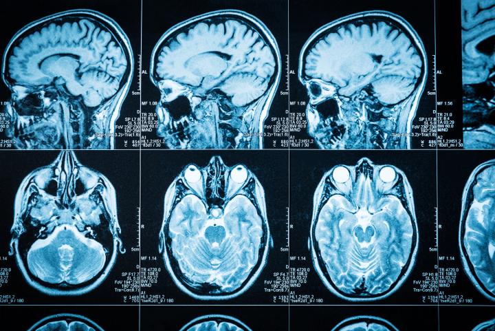 Multiple images from CT scans of the brain