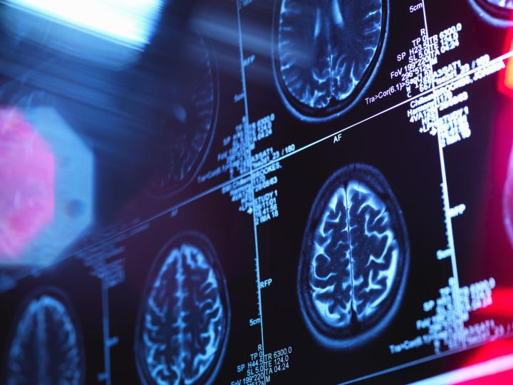 Dementia risk